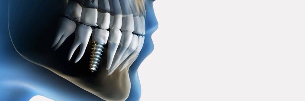 Dental implant procedure